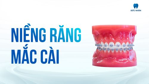 Niềng Răng Mắc Cài